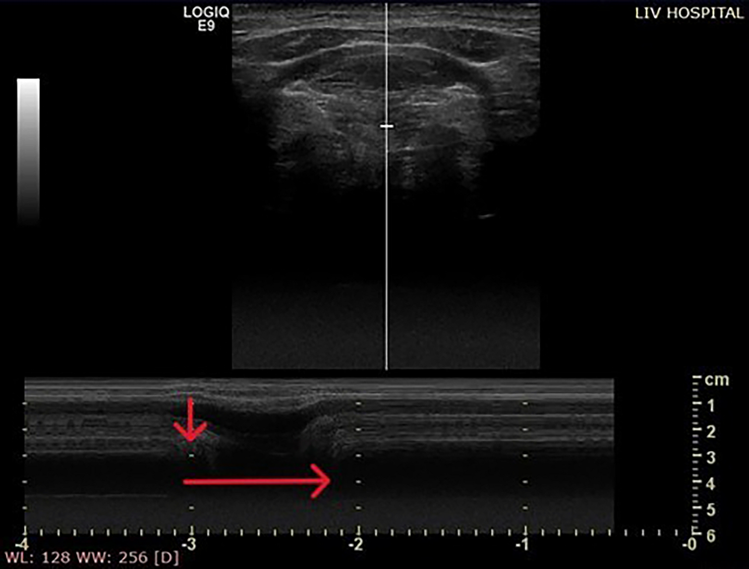 Ultrasound Evaluatıon of Muscle Movement During Swallowing Maneuvers: Trials on 3 Maneuvers