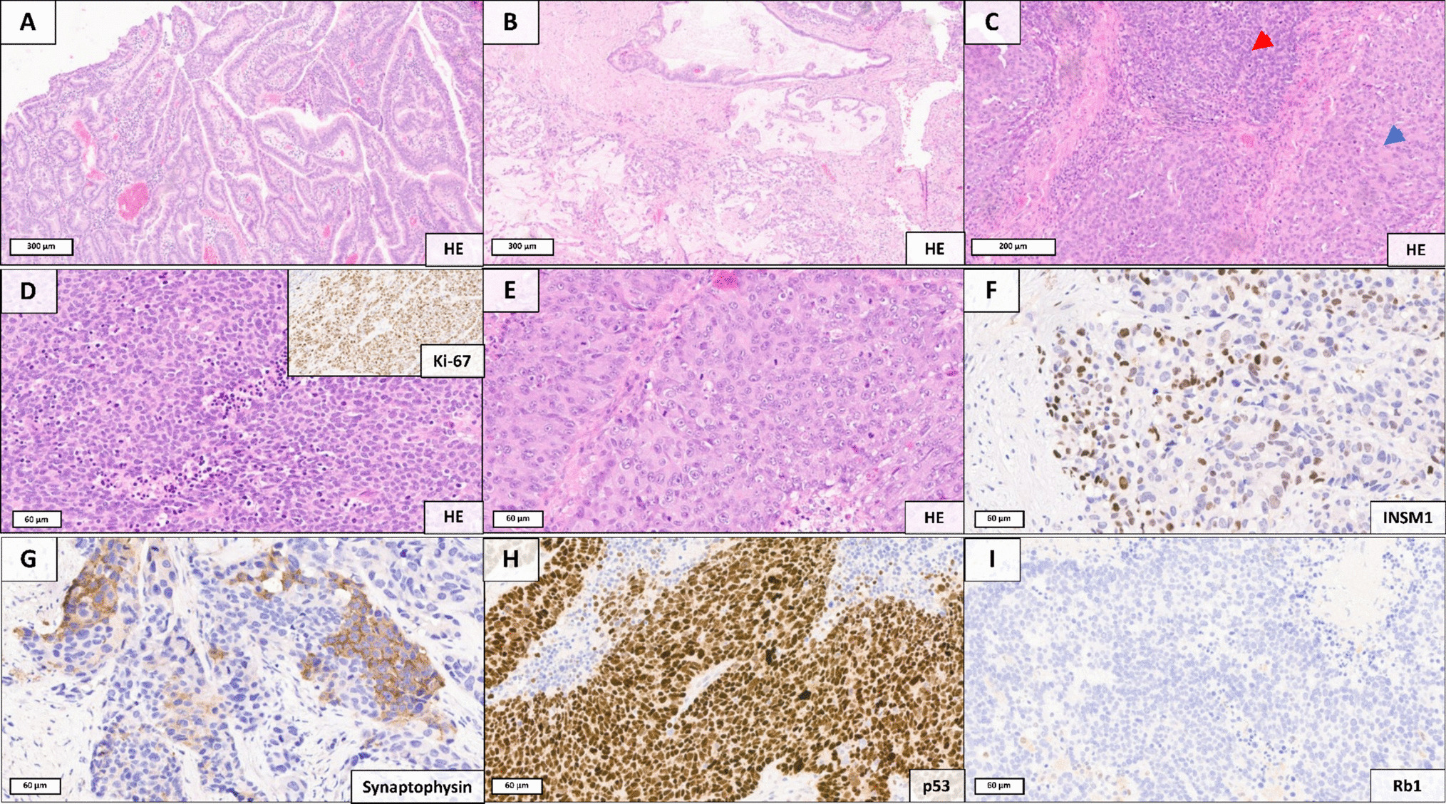 Exploring Intratumoral Heterogeneity in Mixed Neuroendocrine-Nonneuroendocrine Neoplasms with Spatial Transcriptomics: Even More Diverse Than Anticipated
