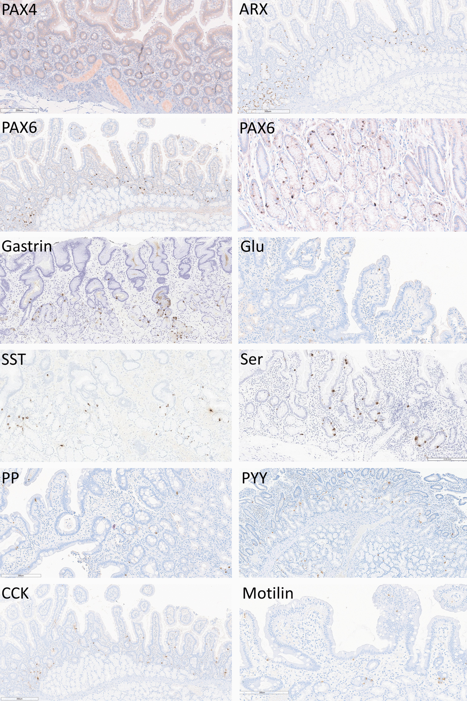 Extended Hormone Profiling Identifies a Wider Network of Duodenal Neuroendocrine Tumor Subtypes