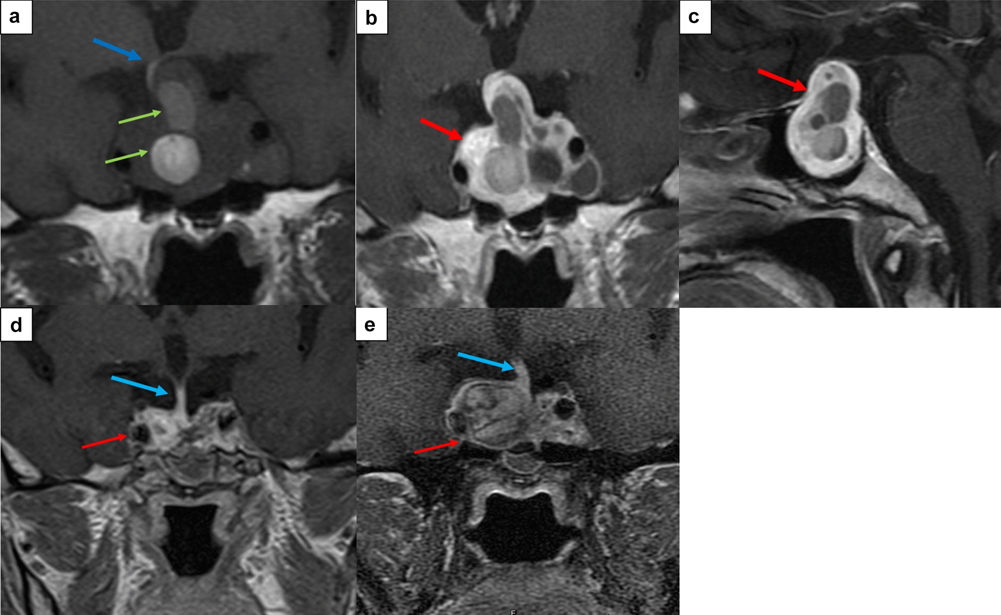 Primary sellar glomus tumor with  mutation: an aggressive tumor of uncertain malignant potential