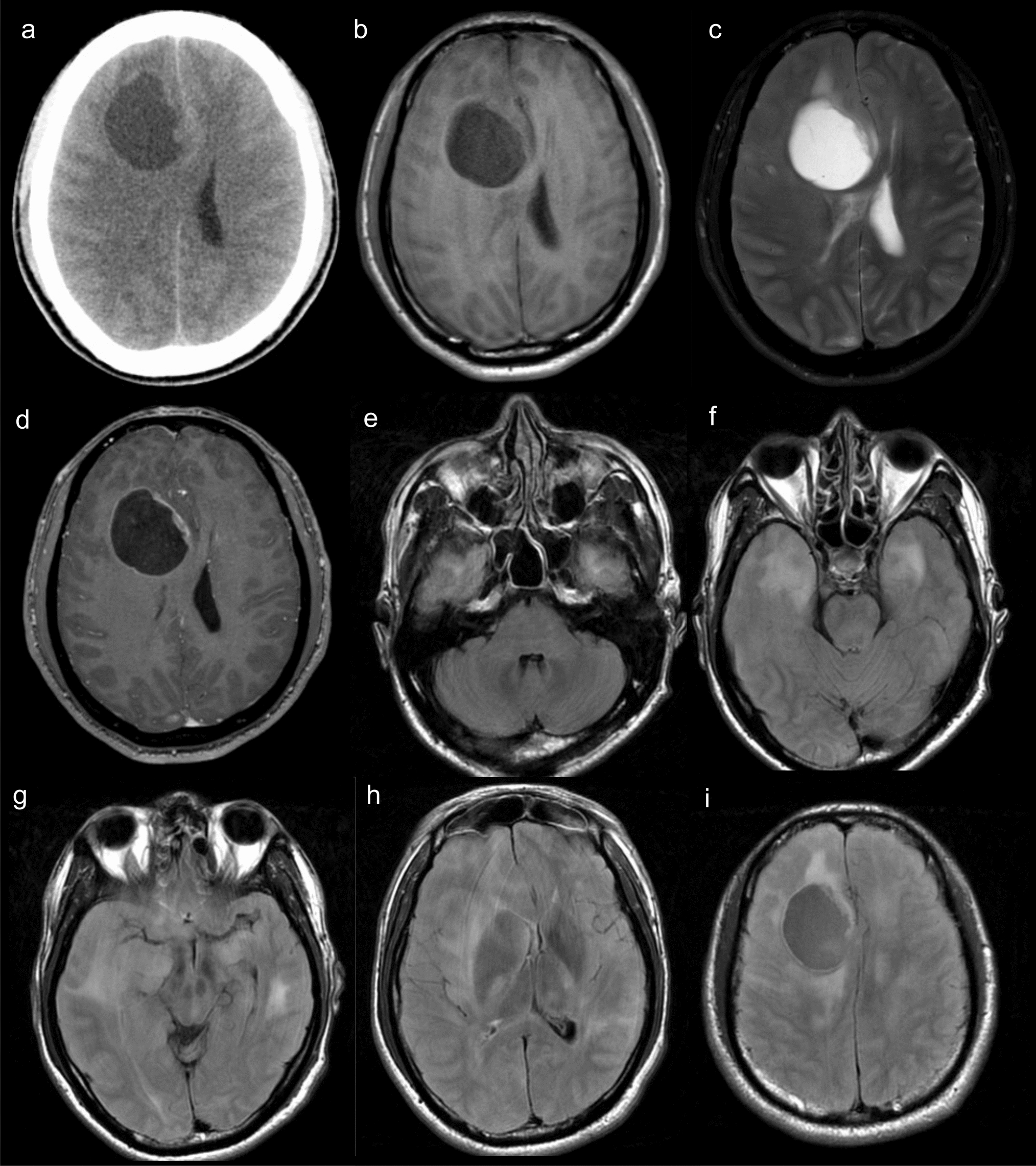 Diffuse midline glioma, H3K27-altered: a rare presentation with gliomatosis cerebri growth pattern and progression toward midline