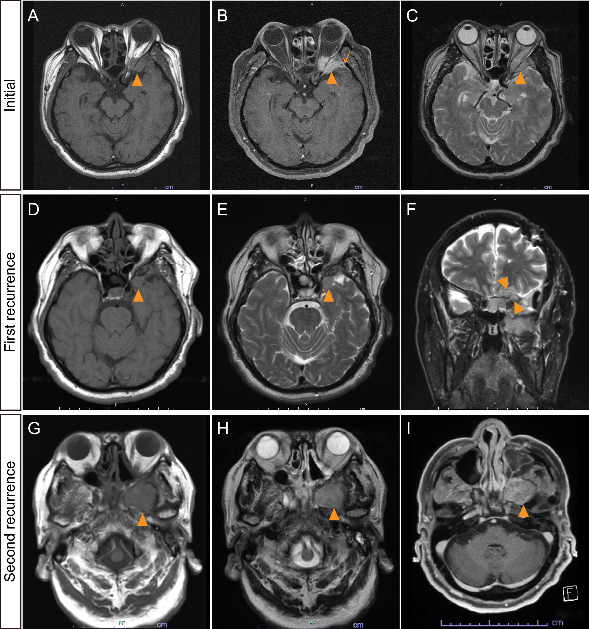 Meningioma with trabecular architecture: a harbinger of BAP1 deficiency