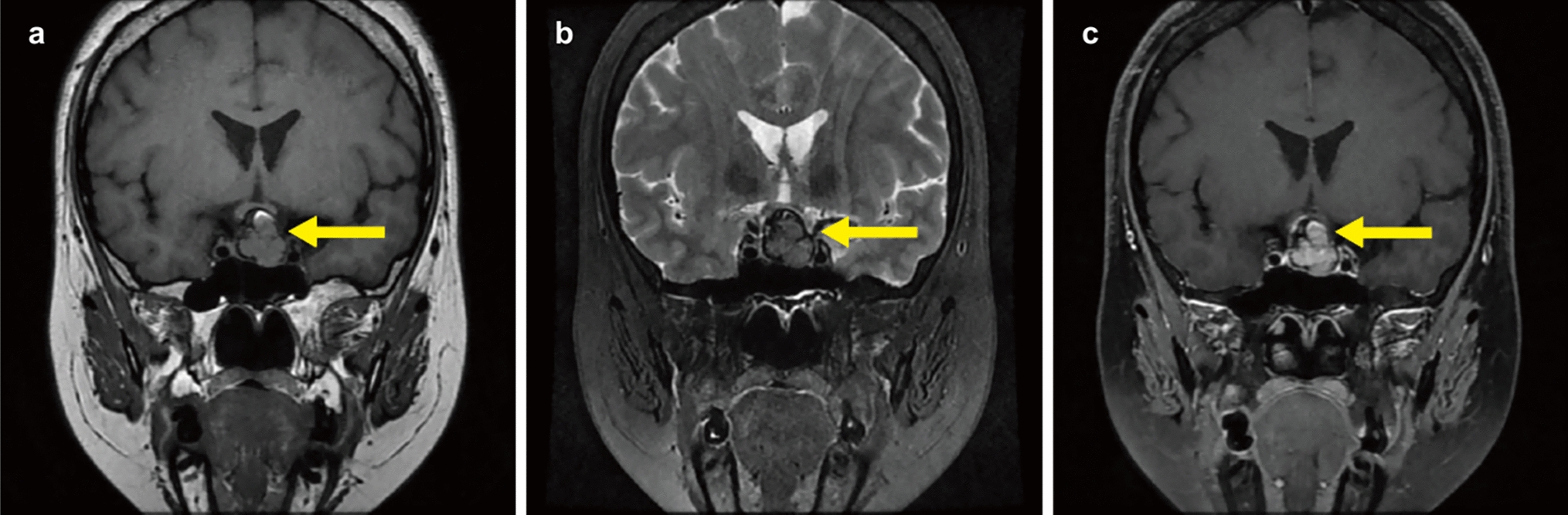 A case of primary papillary epithelial tumor of the sella with reverse polarity and paired box 8 expression