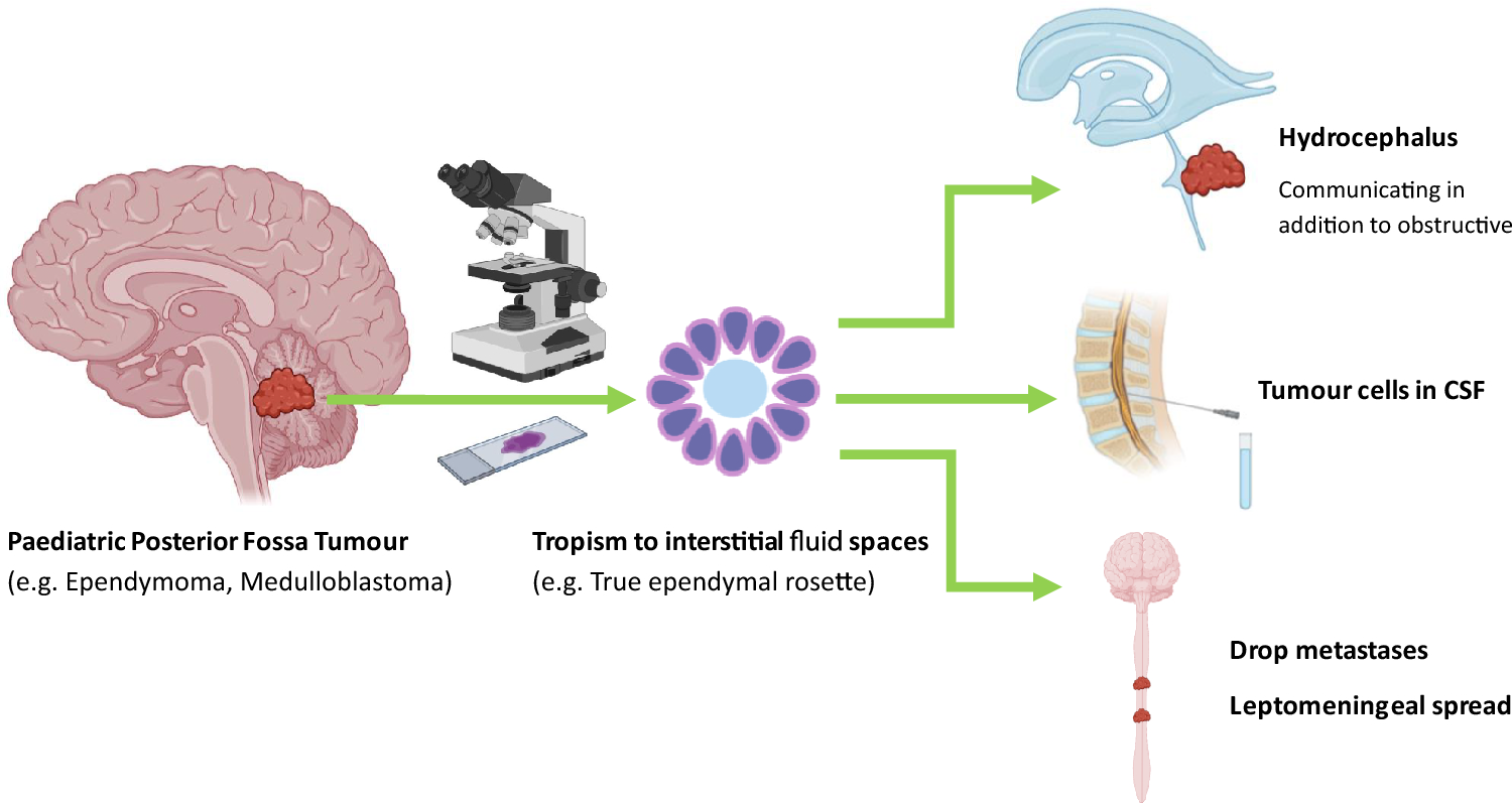 How is rosette formation in brain tumours linked with cerebrospinal fluid spread?