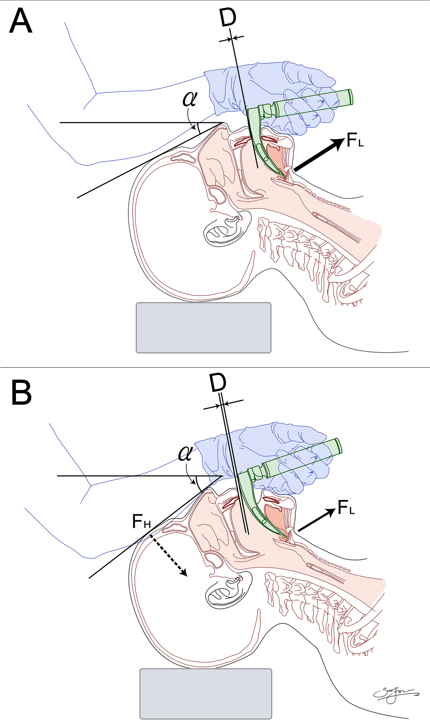 Forearm support to reduce dental contact during direct laryngoscopy: a randomized crossover trial