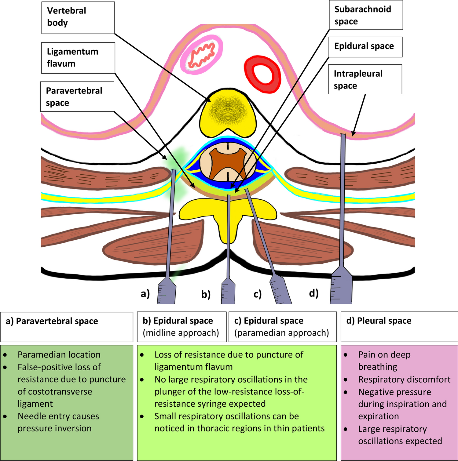 An encounter of unusual pressure dynamics during thoracic epidural placement: a “breathing” syringe