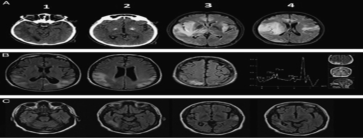 Mitochondrial Encephalomyopathy, Lactic Acidosis, and Stroke-like Episodes (MELAS) Syndrome: Frequency, Clinical Features, Imaging, Histopathologic, and Molecular Genetic Findings in a Third-level Health Care Center in Mexico