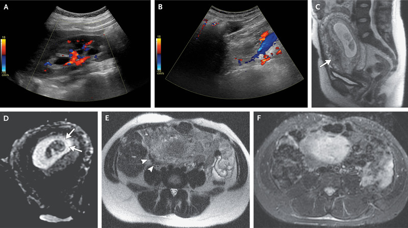 Case 21-2021: A 33-Year-Old Pregnant Woman with Fever, Abdominal Pain, and Headache