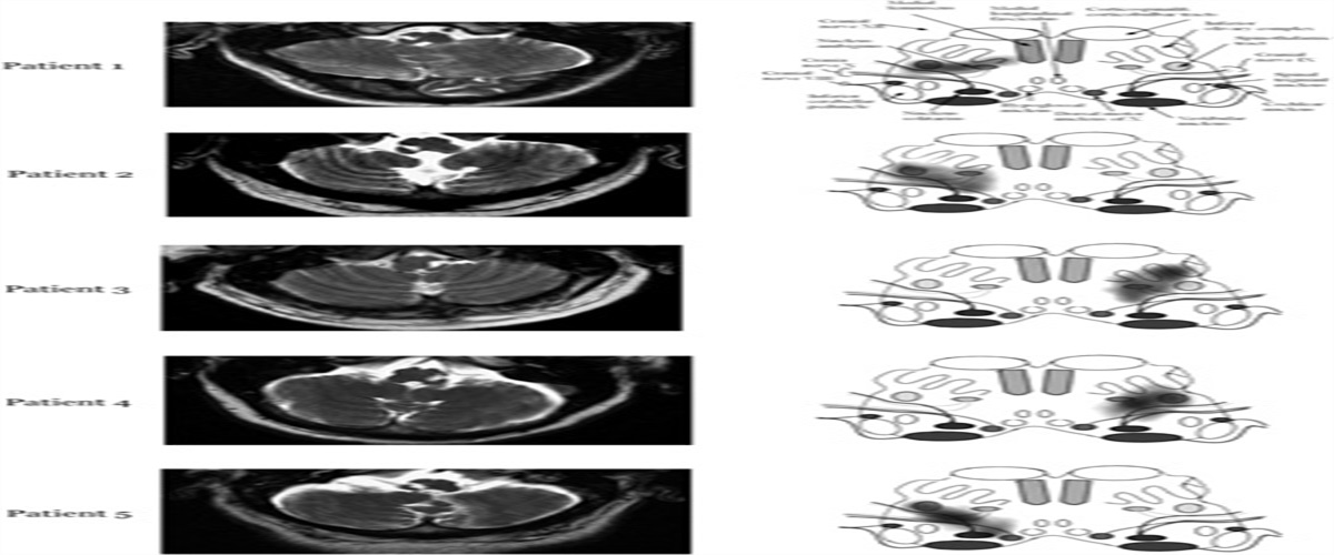 Variants of Avellis Syndrome Due to Medulla Oblongata Infarction: A Case Series