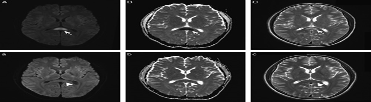 Cytomegalovirus-Associated Mild Encephalopathy/Encephalitis With Reversible Splenial Lesion