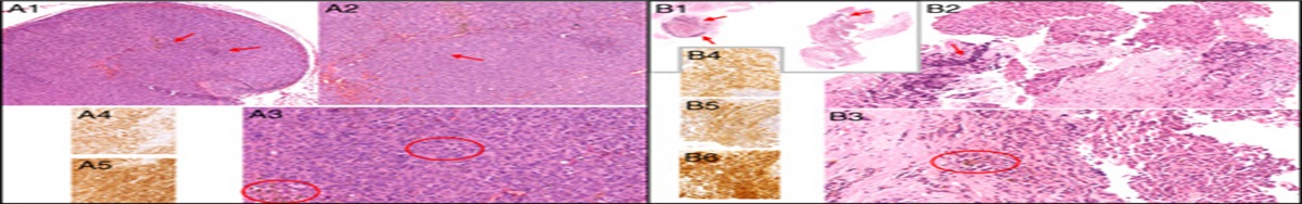 Trigeminal Metastasis of Malignant Melanoma: Clinical, Neuroradiological, and Pathological Features. A Case Report