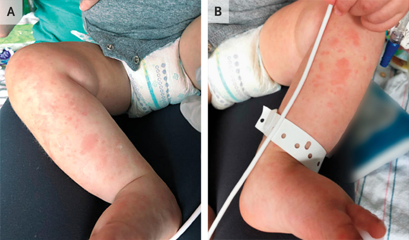 Case 29-2021: A 12-Month-Old Boy with Fever and Developmental Regression