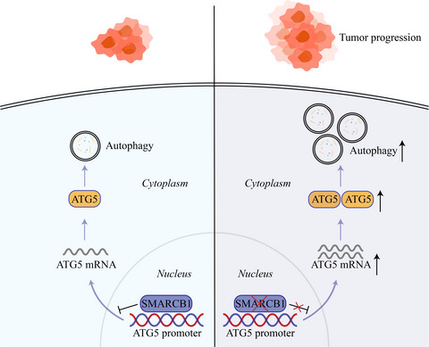 Loss of SMARCB1 promotes autophagy and facilitates tumour progression in chordoma by transcriptionally activating ATG5