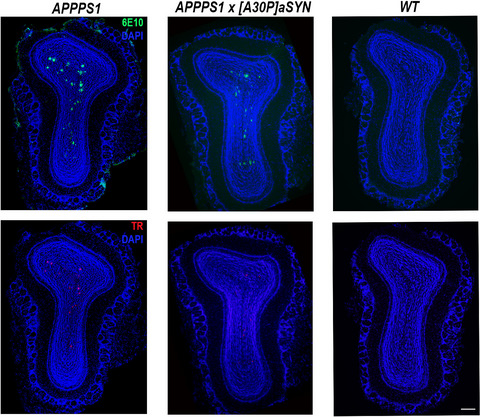 Distinct Aβ pathology in the olfactory bulb and olfactory deficits in a mouse model of Aβ and α‐syn co‐pathology