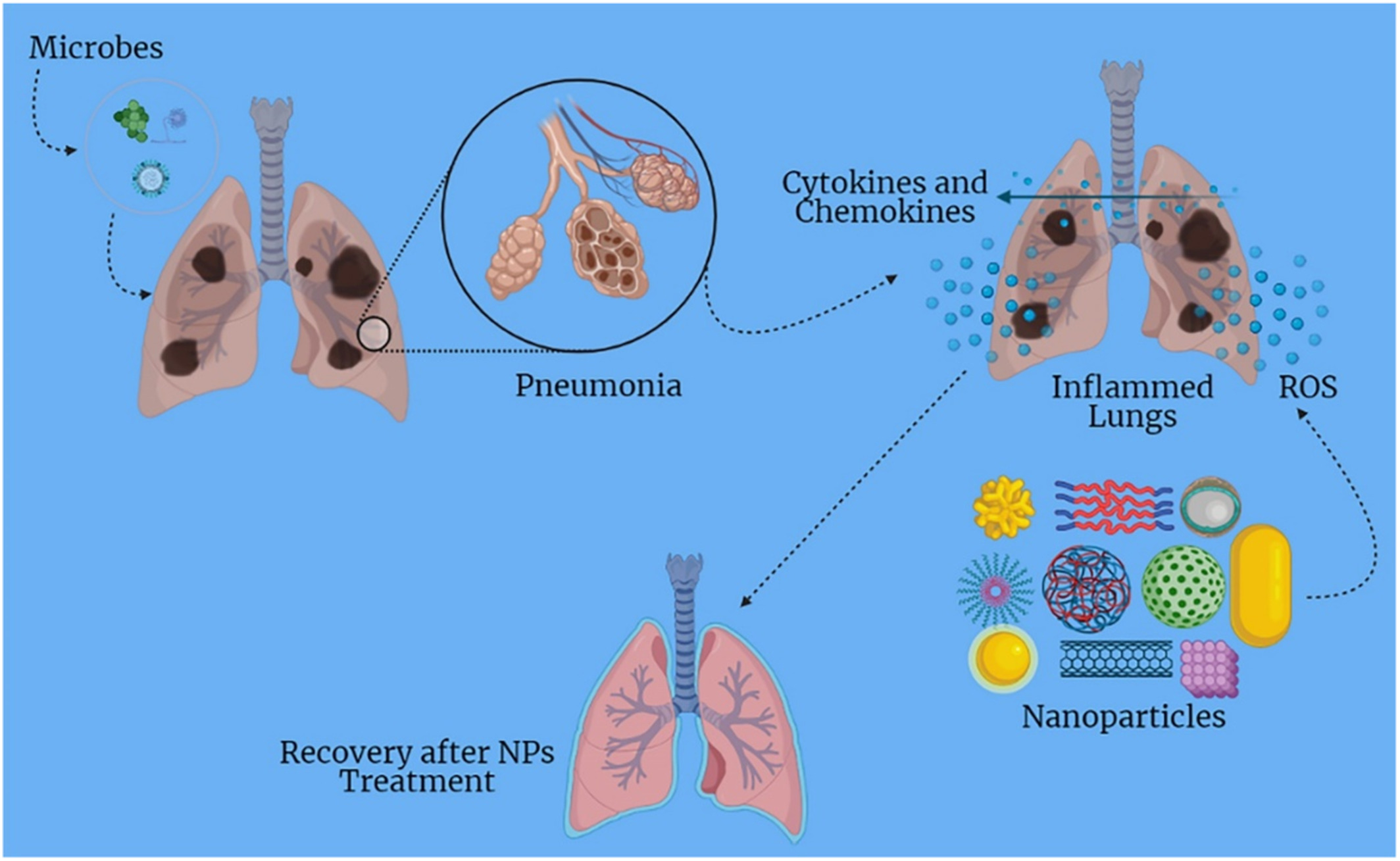 Inflammation‐modulating nanoparticles for pneumonia therapy