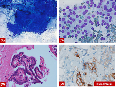 Renal metastasis from papillary thyroid carcinoma: A diagnostic dilemma