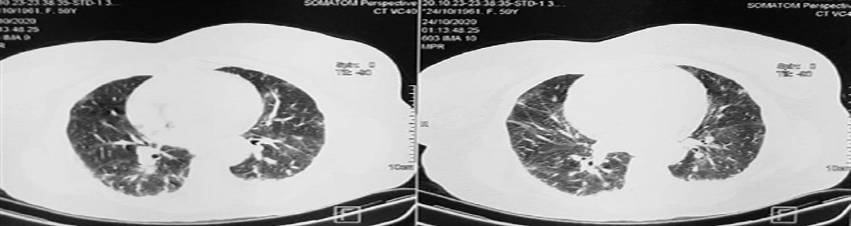 COVID-19 Infection and Recurrent Stroke in Young Patients With Protein S Deficiency: A Case Report