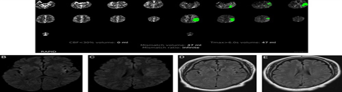 COVID-19 Associated Wake-Up Stroke Treated With DWI/FLAIR Mismatch Guided Intravenous Alteplase: A Case Report