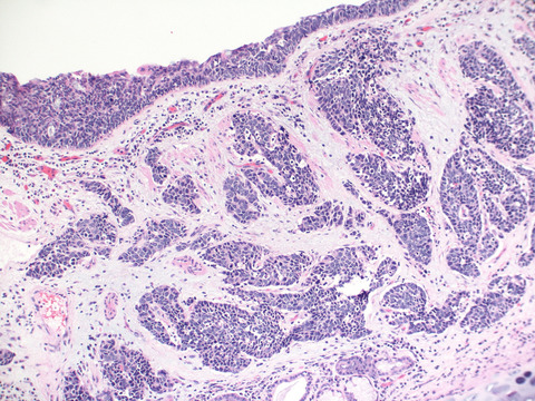 Pulmonary Neuroendocrine Carcinomas in Situ: Do They Exist?