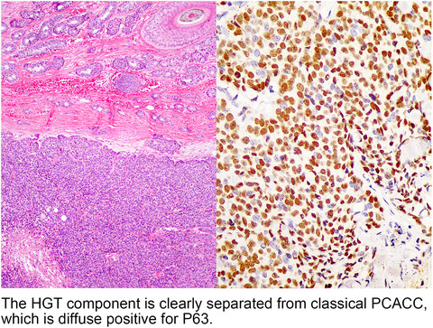Primary cutaneous adenoid cystic carcinoma: a clinicopathologic, immunohistochemical, and fluorescence in‐situ hybridisation study of 13 cases
