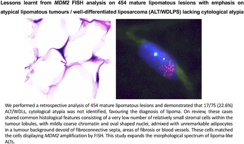 Lessons learnt from MDM2 fluorescence in‐situ hybridisation analysis of 439 mature lipomatous lesions with an emphasis on atypical lipomatous tumour/well‐differentiated liposarcoma lacking cytological atypia