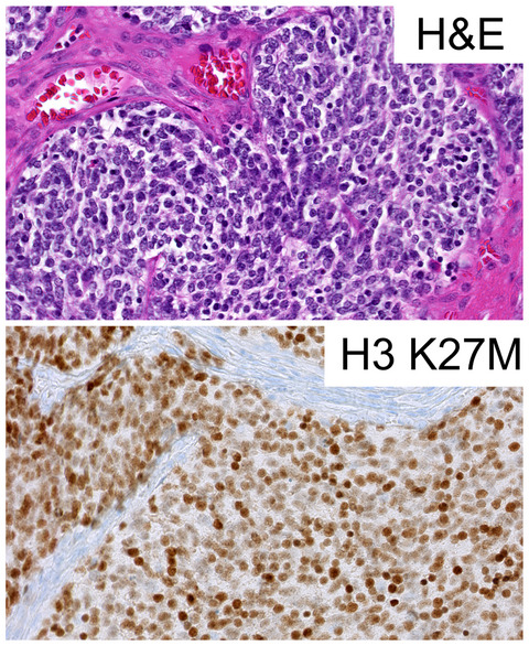 An H3F3A K27M‐mutation in a sonic hedgehog medulloblastoma