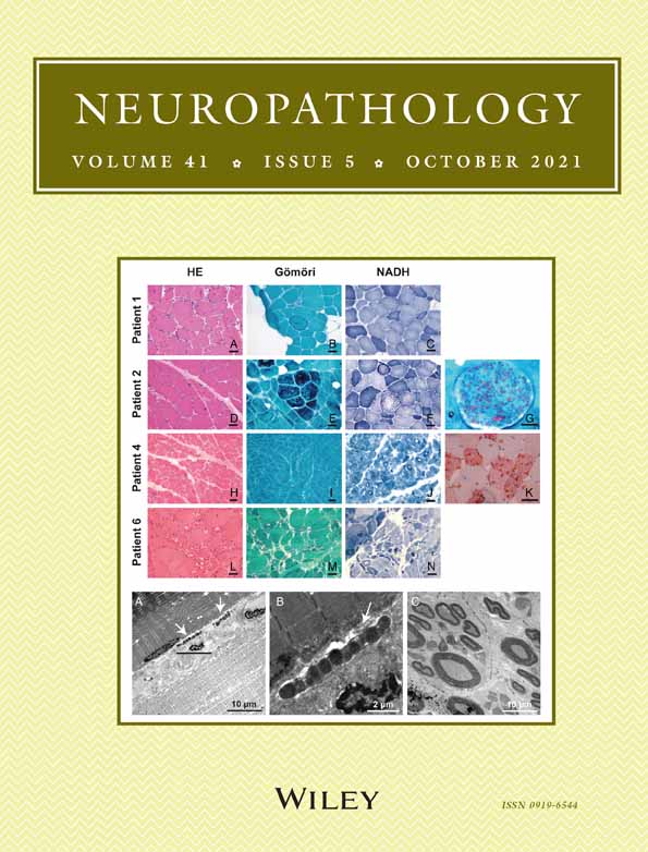 Unexpected postmortem diagnoses in cases of clinically diagnosed amyotrophic lateral sclerosis