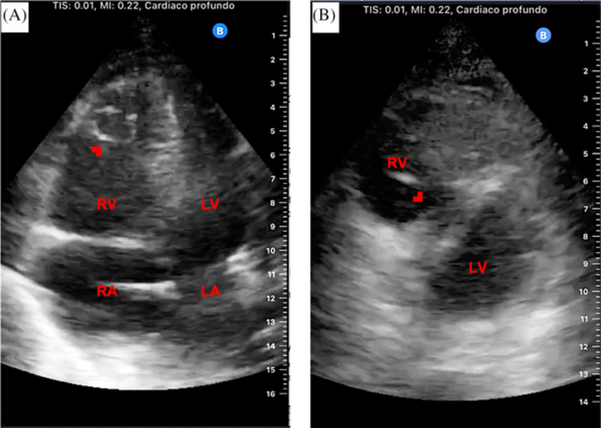 Point‐of‐care ultrasound assessment with handheld ultrasound device attached to cell phone