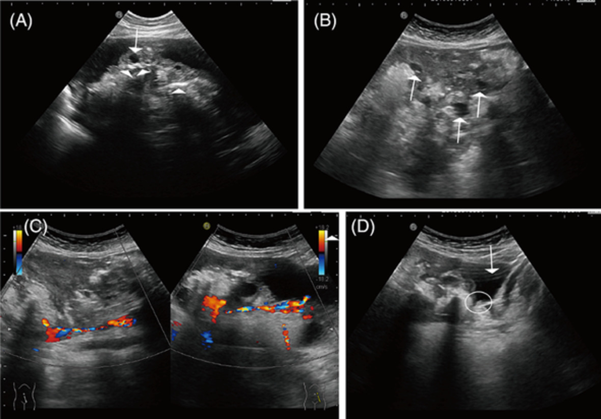 Imaging appearance of ovarian mature teratoma with gliomatosis peritonei