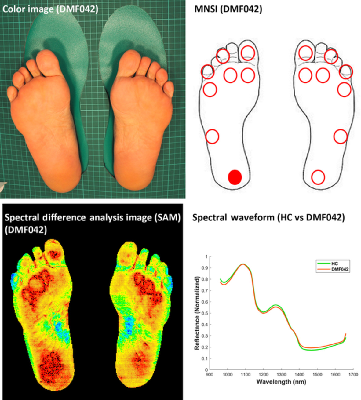 Assessment of diabetic small‐fiber neuropathy by using short‐wave infrared hyperspectral imaging