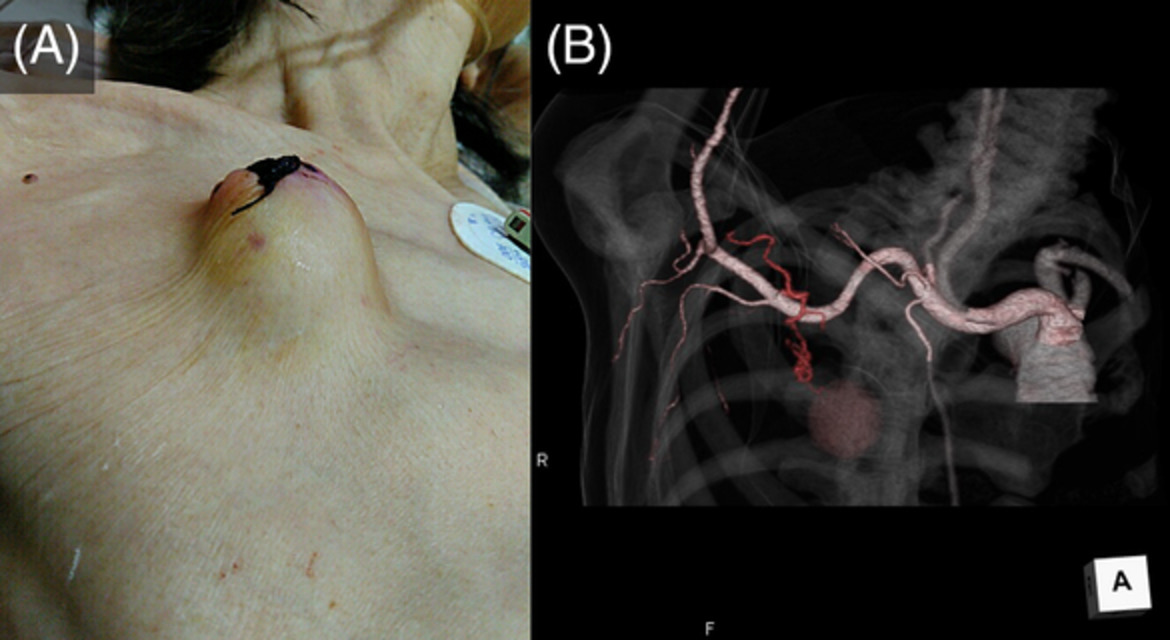 Unexpected haemorrhage from lateral thoracic artery following the removal of a pleural drainage tube