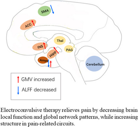 Functional and structural alterations in the pain‐related circuit in major depressive disorder induced by electroconvulsive therapy