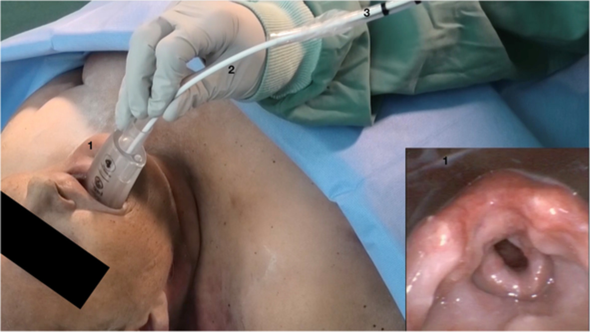 Randomised controlled trial in cadavers investigating methods for intubation via a supraglottic airway device: Comparison of flexible airway scope guided versus a retrograde technique