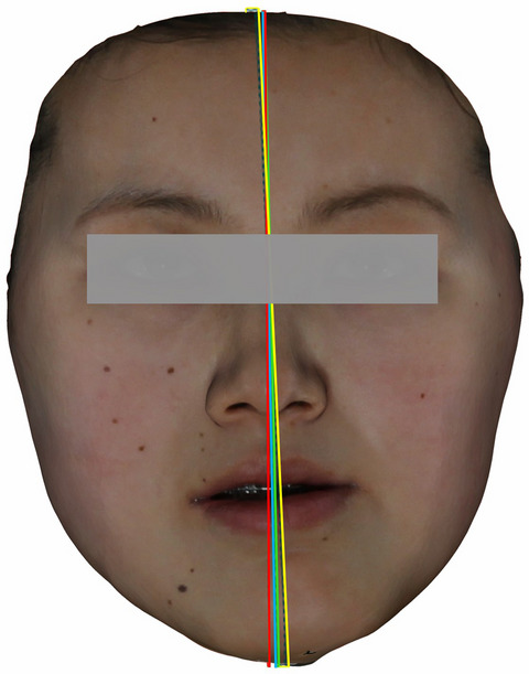 A mathematical algorithm of the facial symmetry plane: Application to mandibular deformity 3D facial data