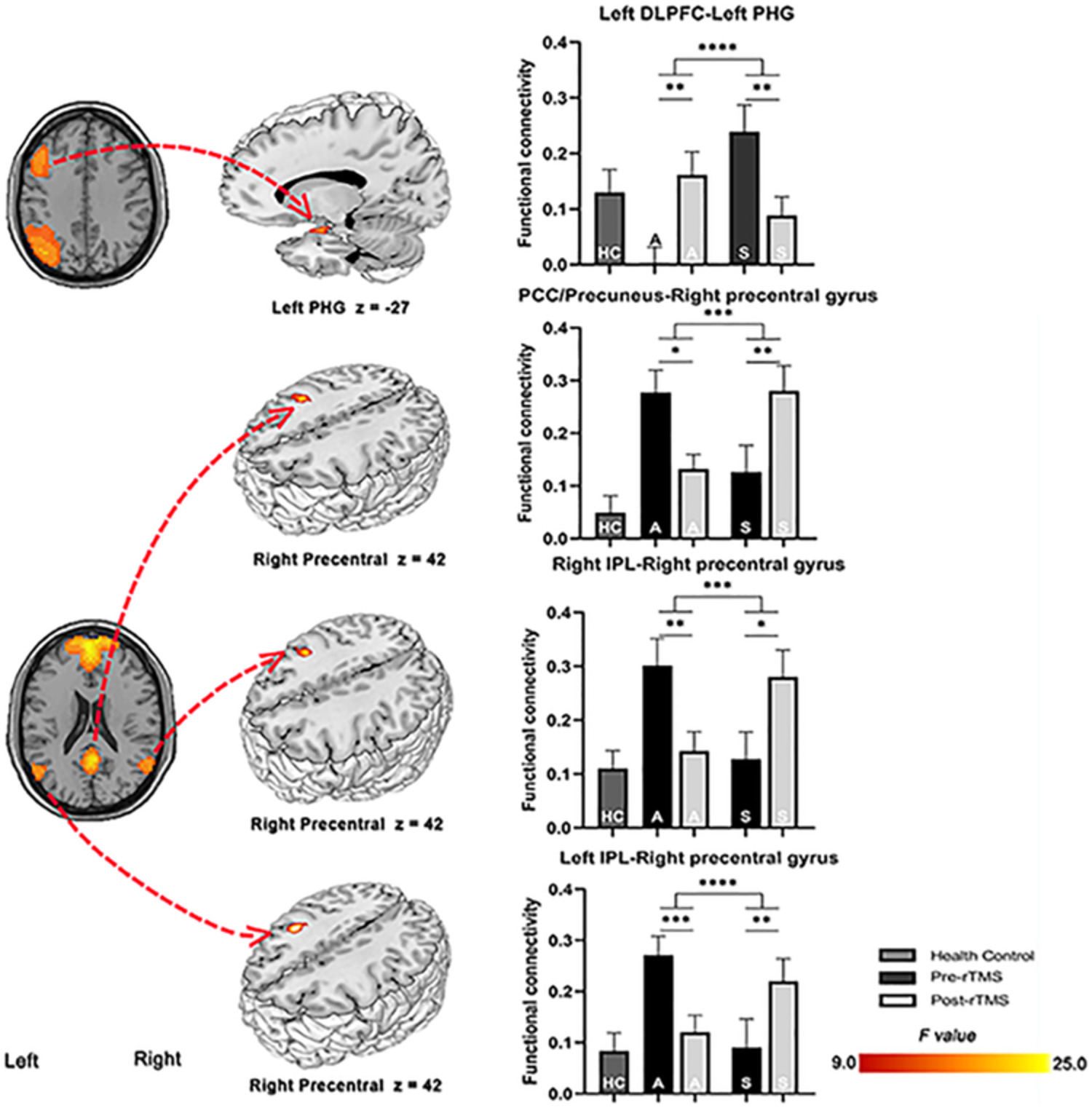 Repetitive transcranial magnetic stimulation modulates coupling among large‐scale brain networks in heroin‐dependent individuals: A randomized resting‐state functional magnetic resonance imaging study