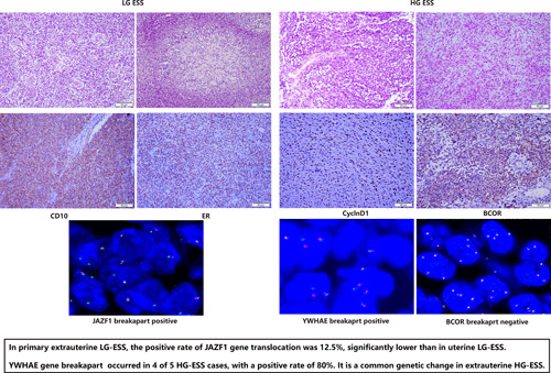 JAZF1, YWHAE, and BCOR Gene Translocation in Primary Extrauterine Low‐Grade and High‐Grade Endometrial Stromal Sarcomas