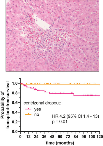 Centrizonal hepatocyte dropout in allograft liver biopsies: A clinicopathologic study