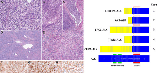 ALK rearrangements in infantile fibrosarcoma‐like spindle cell tumors of soft tissue and kidney