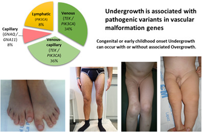 Segmental undergrowth is associated with pathogenic variants in vascular malformation genes: A retrospective case‐series study