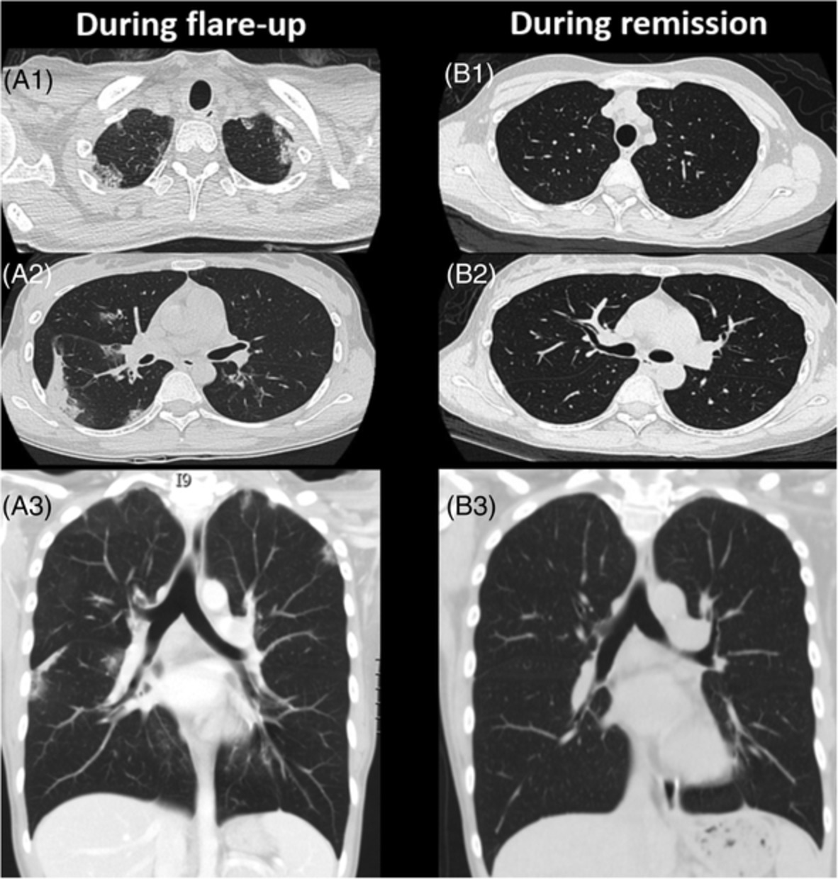 Switching from omalizumab to mepolizumab therapy improved extra‐pulmonary abdominal and cutaneous vasculitis symptoms in a patient with eosinophilic granulomatosis with polyangiitis