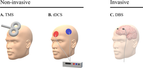 Brain stimulation: a therapeutic approach for the treatment of neurological disorders