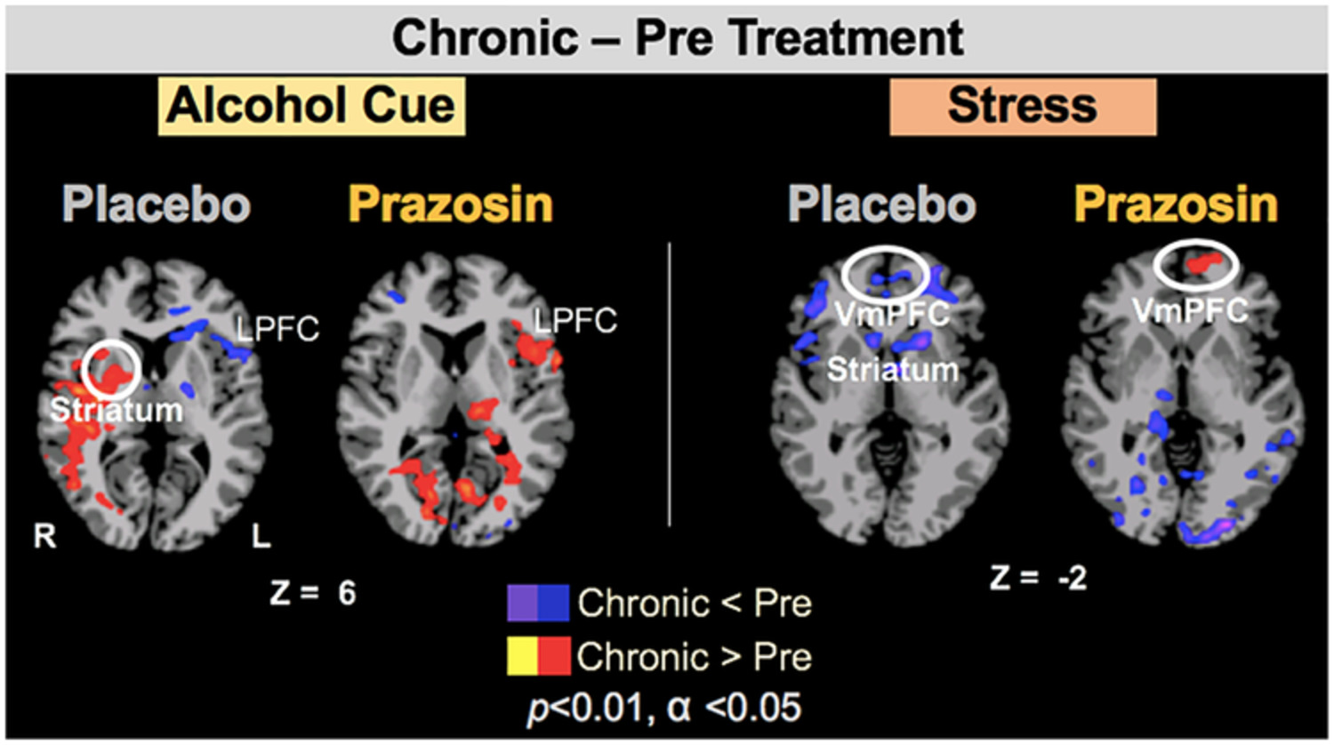 Alcohol withdrawal symptoms predict corticostriatal dysfunction that is reversed by prazosin treatment in alcohol use disorder