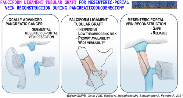Falciform ligament tubular graft for mesenteric‐portal vein reconstruction during pancreaticoduodenectomy 