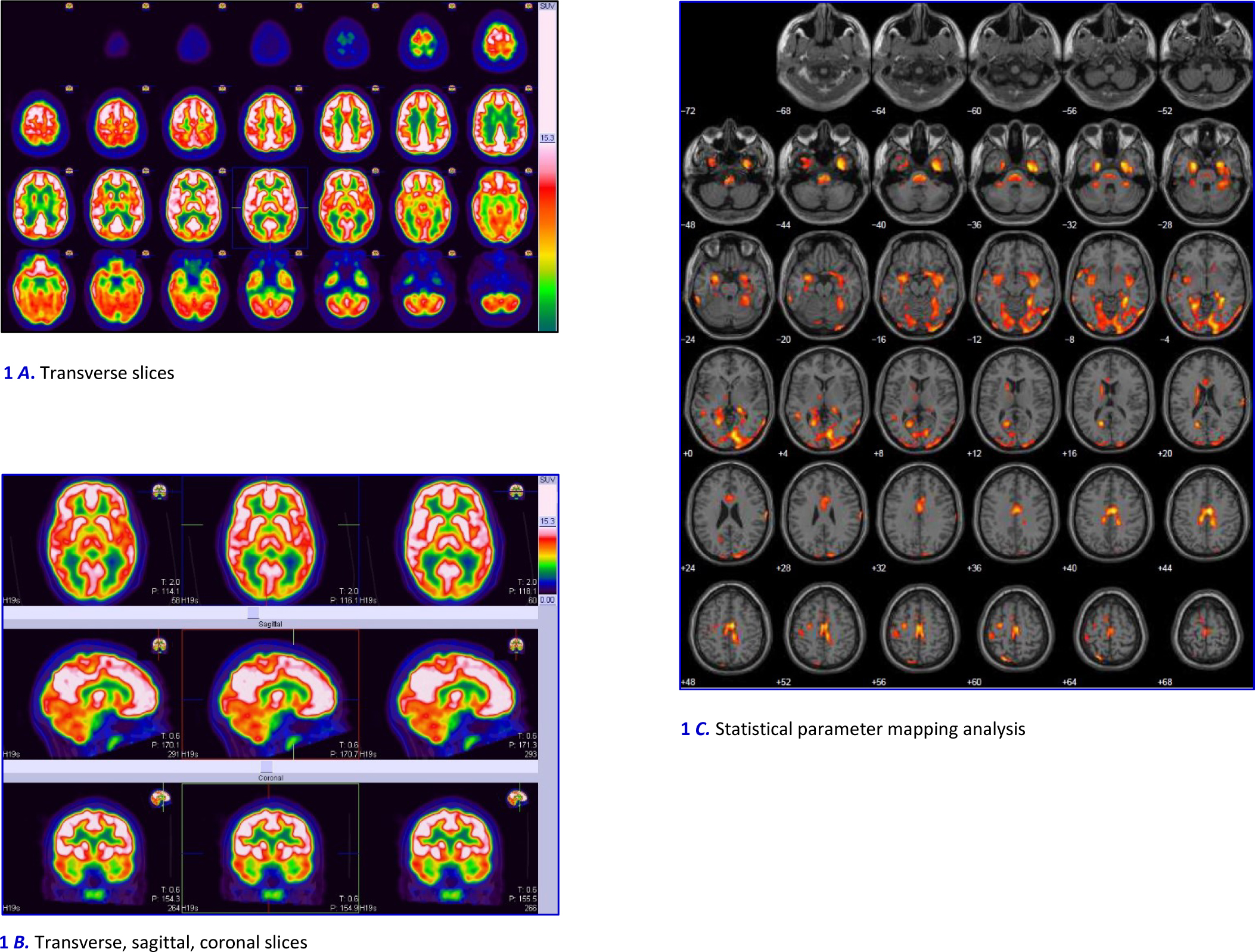 Widespread cortical PET abnormalities in an adolescent related to a PNES dissociative state, PTSD, ADHD, and domestic violence exposure