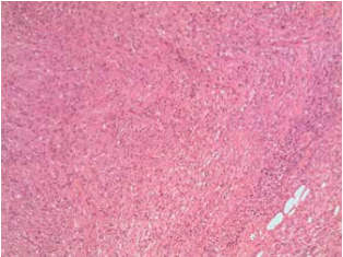 Inflammatory pseudotumor of the parotid gland: a case report