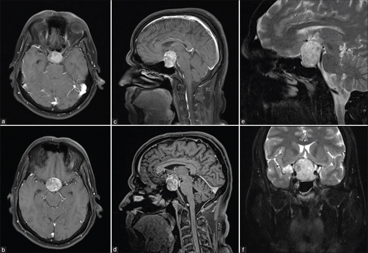 Neuro-ophthalmic presentation of COVID-19 disease: A case report
