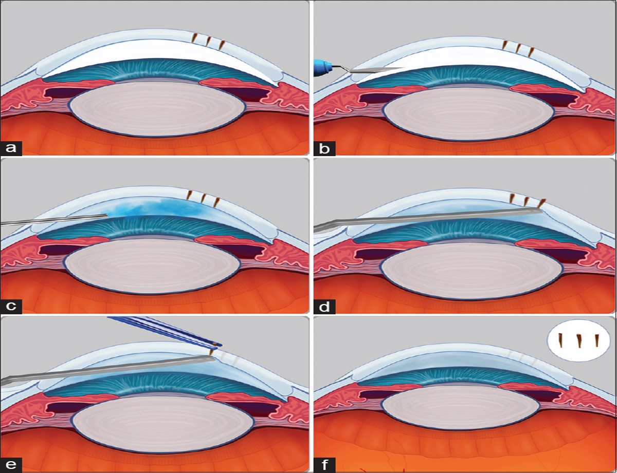 Removal of full-thickness vertical corneal stromal wooden foreign bodies: An innovative ab-interno technique