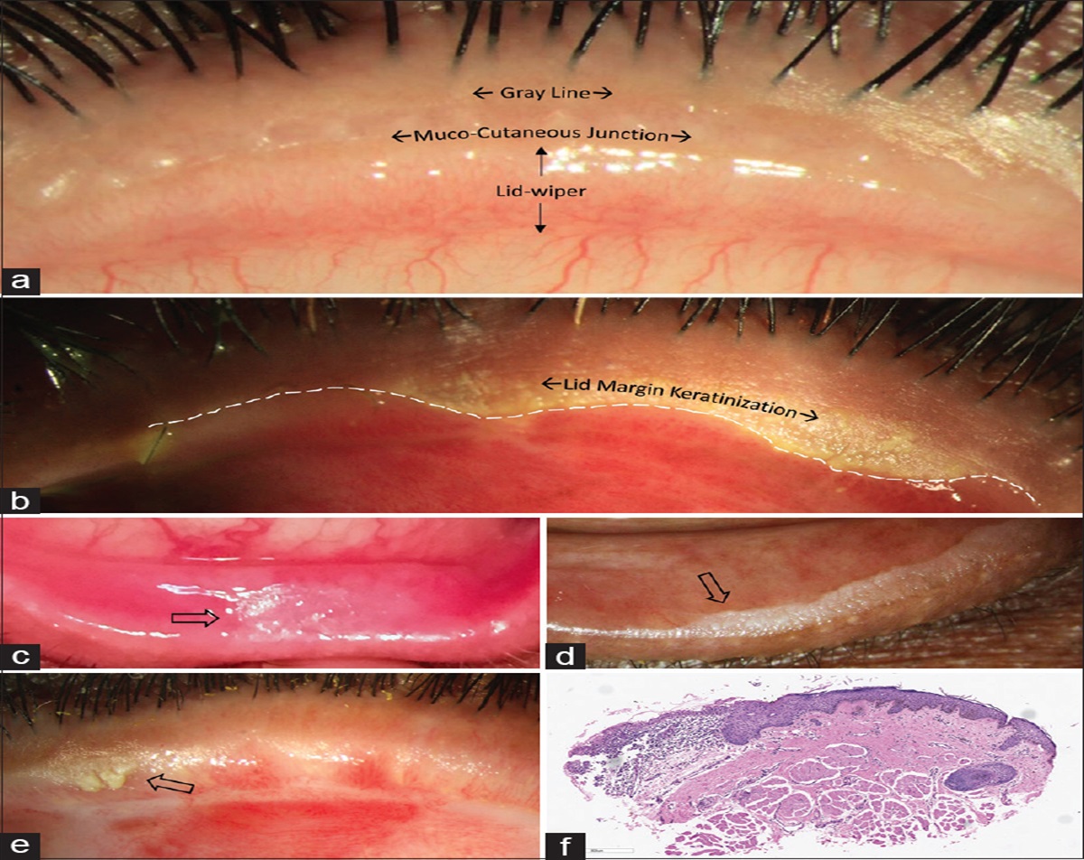 A beginner's guide to mucous membrane grafting for lid margin keratinization: Review of indications, surgical technique and clinical outcomes
