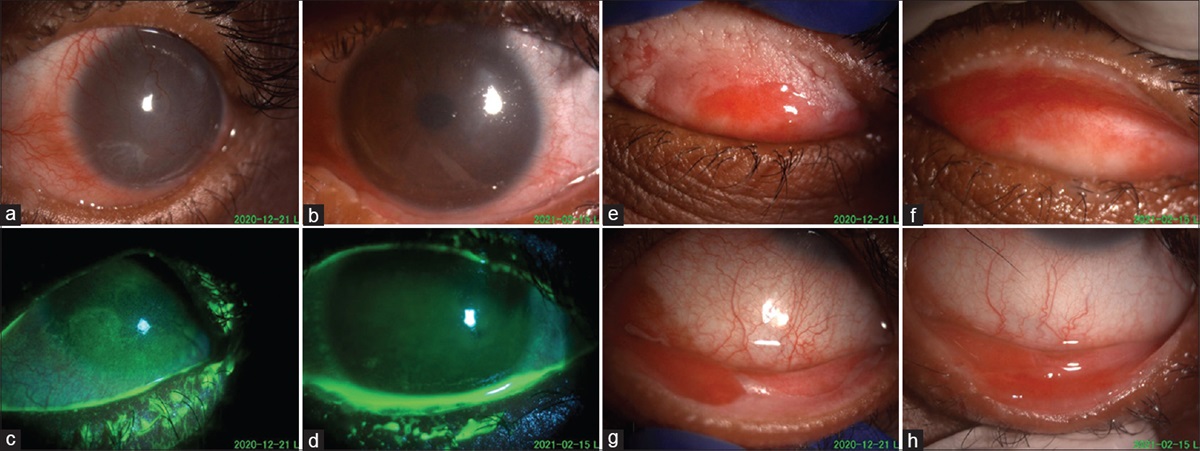 Mucous membrane grafting for lid margin keratinization in Stevens Johnson syndrome - An eye opening saga