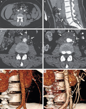 Case 16-2021: A 37-Year-Old Woman with Abdominal Pain and Aortic Dilatation